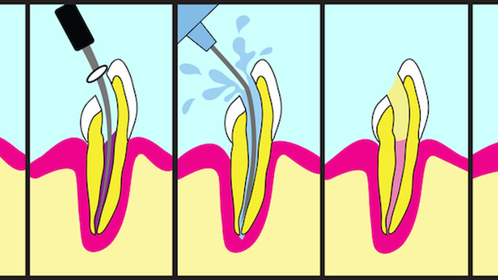 Root Canal Cover Up Exposed